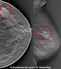 The breast is flattened between two panels. Mammography 3d Mammography Tomosynthesis Densebreast Info Inc