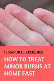 Home Remedies For Burns What Do You Put On A Minor Burn Burn Skin Home Remedies Home Remedies For Burns Burn Remedy