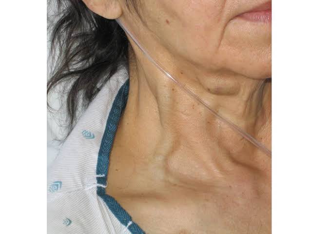 Nổi tĩnh mạch trên cơ thể là dấu hiệu bệnh gì? Đây chính là những gợi ý  giúp bạn nhận biết