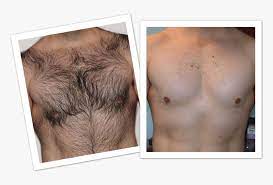Laser hair removal uses laser light pulses to selectively destroy hair follicles by targeting the melanin (colour) in them. Mens Laser Hair Removal Before And After Hd Png Download Kindpng
