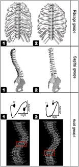 What causes upper abdominal pain under ribs? The Rib Cage Sagittal And Axial Subtypes Rib Cage Subtype Included Download Scientific Diagram