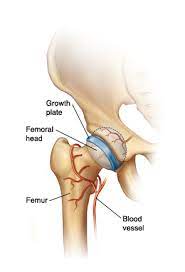 When Your Child Has Legg Calve Perthes Disease
