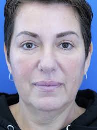 Cases in Blepharoplasty Upper