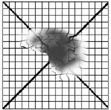 Amsler Grid