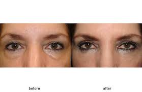 How to fix hollow eyes. Eyelid Lift Blepharoplasty Photos Eyelid Lift Under Eye Mask Skin