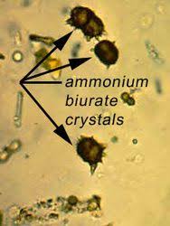Urinalysis Crystals Medical Laboratory Science Medical Laboratory Medical Laboratory Scientist