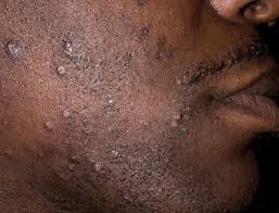 How To Get Rid Of Shaving Bumps On Face Legs Overnight Fast Neck Arms Down There Razor Burn Rash Ing Razor Bump Treatment Shaving Bumps Ingrown Hair