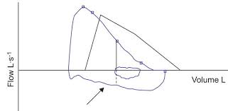 Image result for Vocal Cord Dysfunction