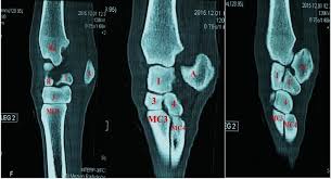 Capitate and all other carpal bones lie posterior to lunate on lateral radiograph. Sagittal Scans Of The Carpal Joint From Medial To Lateral 1 First Download Scientific Diagram