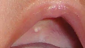 Image result for Canker sores symptoms roof of the mouth