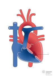 Image result for Ventricular Septal Defect