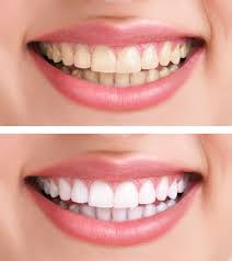 All professional grade teeth whitening products contain hydrogen peroxide or carbamide peroxide, which is the bleaching (or stain removing) agent. How Can I Remove Smoking Stains From My Teeth Dr Quiec