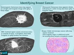 As with all abnormalities seen on breast imaging, the diagnosis of dcis requires a sample of tissue or biopsy. Breast Masses Cancerous Tumor Or Benign Lump