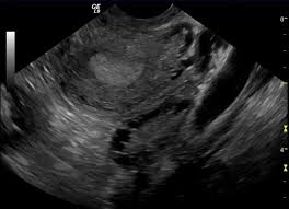 Pcos can cause missed or irregular menstrual periods, excess hair growth, acne, infertility, and weight gain. A Look At Polycystic Ovary Syndrome The Crimson White