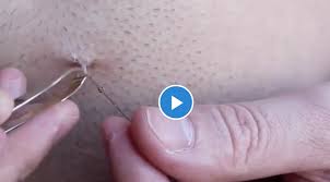 That's what is actually damaged with noise exposure. dr. Longest Ingrown Hair Removal From Abdomen Medical Videos