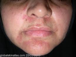 Oral antibiotics are best for severe rosacea. Perioral Dermatitis Dermatologic Disorders Merck Manuals Professional Edition