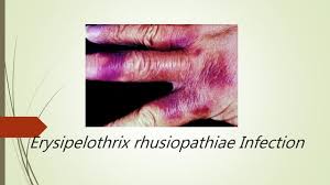 Image result for Erysipeloid