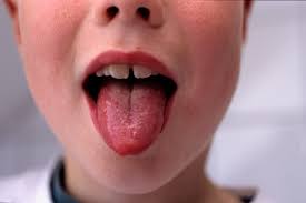Viral meningitis is the most common type and can be relatively mild (some sufferers are not even aware that they have an infection). What Is Scarlet Fever Symptoms Rash How It Spreads And Affects Adults Metro News