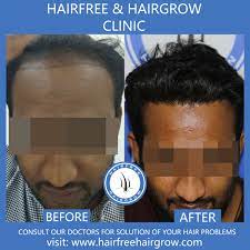 Hair Transplant Review Hair Transplant Best Hair Transplant Cool Hairstyles