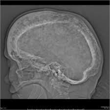 Cotton Wool Appearance Of Bone Radiology Reference Article Radiopaedia Org Pagets Disease Radiology Medical Videos