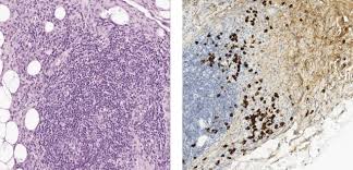 Image result for Dacryoadenitis