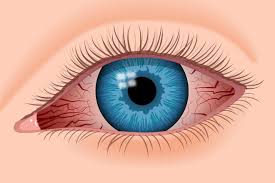 19 Causes And Treatments For Red Eyes Dry Eye Symptoms Swollen Eyes Eye Infections
