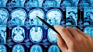 To lower the risk of thyroid cancer, avoid unnecessary exposure to radiation, including radiation from medical imaging procedures, especially in young children and around the head and neck. What Causes Brain Tumors Brain Tumor Treatment Prognosis And More