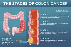 A weight loss of 10 pounds or more, when you haven't changed your diet and exercise habits, could be cancer, especially if you also have other colon cancer symptoms. Colon Cancer Symptoms Causes And Support Strategies