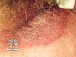 Image result for sore skin in the groin area
