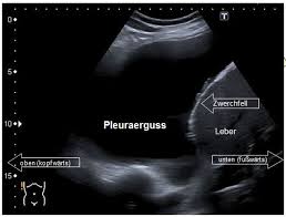 Zusätzlich bei sekundärem spontanpneumothorax oder als alternative aufnahmemethode bei bettlägrigen patienten; Anwendung Des Ultraschalls Am Brustkorb Degum