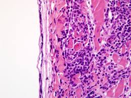 The middle layer is the myocardium, and the innermost layer is the endocardium, which originated from mesothelial cells of the outflow tract. Conference 08 2008 Case 4 20081105