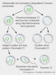 Down Syndrom Trisomie 21 Symptome Folgen Ursache Netdoktor