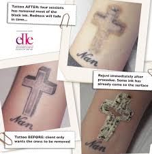 Rejuvi Non Laser Tattoo Removal Procedure Quite A Stubborn Black Tattoo On The Ankle Area Will Need One More Sessi Laser Tattoo Removal Tattoo Removal Tattoos