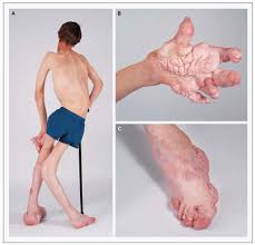 Sep 19, 2017 · proteus syndrome got its name from the greek god proteus, who would change his shape to elude capture. Clinical Manifestations Of The Proteus Syndrome In A 12 Year Old Boy Download Scientific Diagram