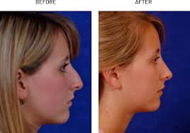 In rhinoplasty surgery, one of the most delicate and traumatic moments is the execution of the osteotomy, which is. Rhinoplasty Austin Nose Surgery West Lake Hills