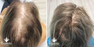 Alopecia is a pathological hair loss. Prp For Hair Loss 6 Frequently Asked Questions Cosmetic Dermatology Center