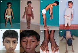 Image result for Myopathy