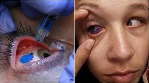 This is a process of altering the color of the eye permanently. Delhi Man Is First To Get Eyeballs Tattooed But Be Careful If You Want One Too Lifestyle News The Indian Express