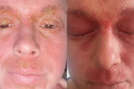 Fundraiser by Chloe Chapman : Chloe's Skin Healing Journey