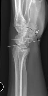Image result for Scapholunate Dislocation