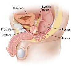 The pancreas is an organ that releases enzymes involved with digestion, and hormones to regular blood sugar levels. What Is Prostate Cancer