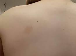 In contrast, café au lait lesions of neurofibromatosis have smooth borders (coast of california). Was Das Fur Ein Fleck Haut Flecken