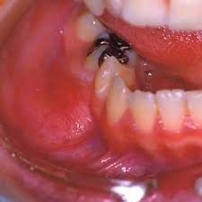 A dry socket looks like a hole left after tooth extraction, where exposed bone within the socket or around the perimeter is visible. Pdf Periosteal Osteosarcoma Of The Jaw Bones A Clinicopathological Review