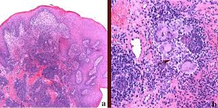 Recessed lighting installation necrotizing granulomatous inflammation. Non Infectious Granulomatous Lesions Of The Orofacial Region Springerlink