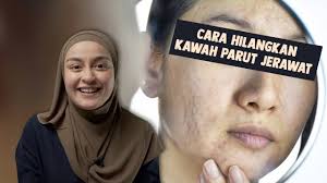 Cara hilangkan jerawat dengan timun cukup mudah, caranya kisar timun dan tapiskan hampasnya. Cara Hilangkan Kawah Parut Jerawat Youtube