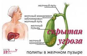 как избавиться от полипов в желчном пузыре народными методами Kamni V Zhelchnom Puzyre K Kakomu Vrachu Obrashatsya