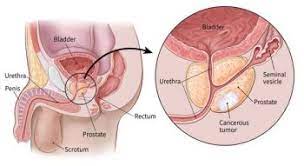 Instead of worrying about &#x27;can soy milk make you gain weight,&#x27; it is better to consider other more serious allegations about cancer and nutrient deficiencies. If You Have Prostate Cancer