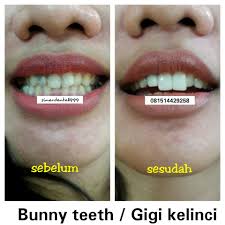 Kelemahan veneer jenis ini adalah rawan terlepas dalam waktu dekat setelah proses pemasangan. Bentuk Panjang Pendek Gigi Veneer Gigi Kelinci Facebook
