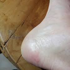 An armpit rash is an itchy and irritating nuisance that is often caused by a bacterial or fungal infection, or contact dermatitis. How To Treat And Prevent A Ski Boot Blister