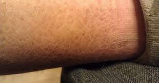 O plaques often follow a symmetrical pattern and usually appear on knees, elbow, trunk and scalp. Kulit Kering Punca Simptom Dan Rawatan The Diagnosa